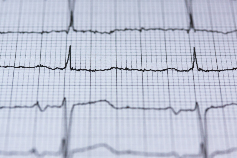 Hacer electrocardiogramas a los adolescentes es la mejor manera de prevenir la muerte súbita