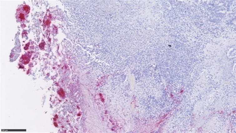 Las bacterias intestinales pueden generar metástasis en tumores de cáncer de colón