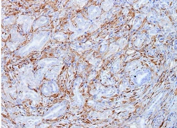 ​Descubren que inhibir una proteína podría frenar el cáncer de páncreas