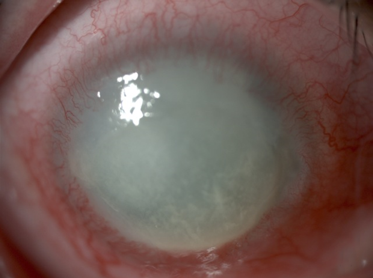 Queratitis por Acanthamoeba