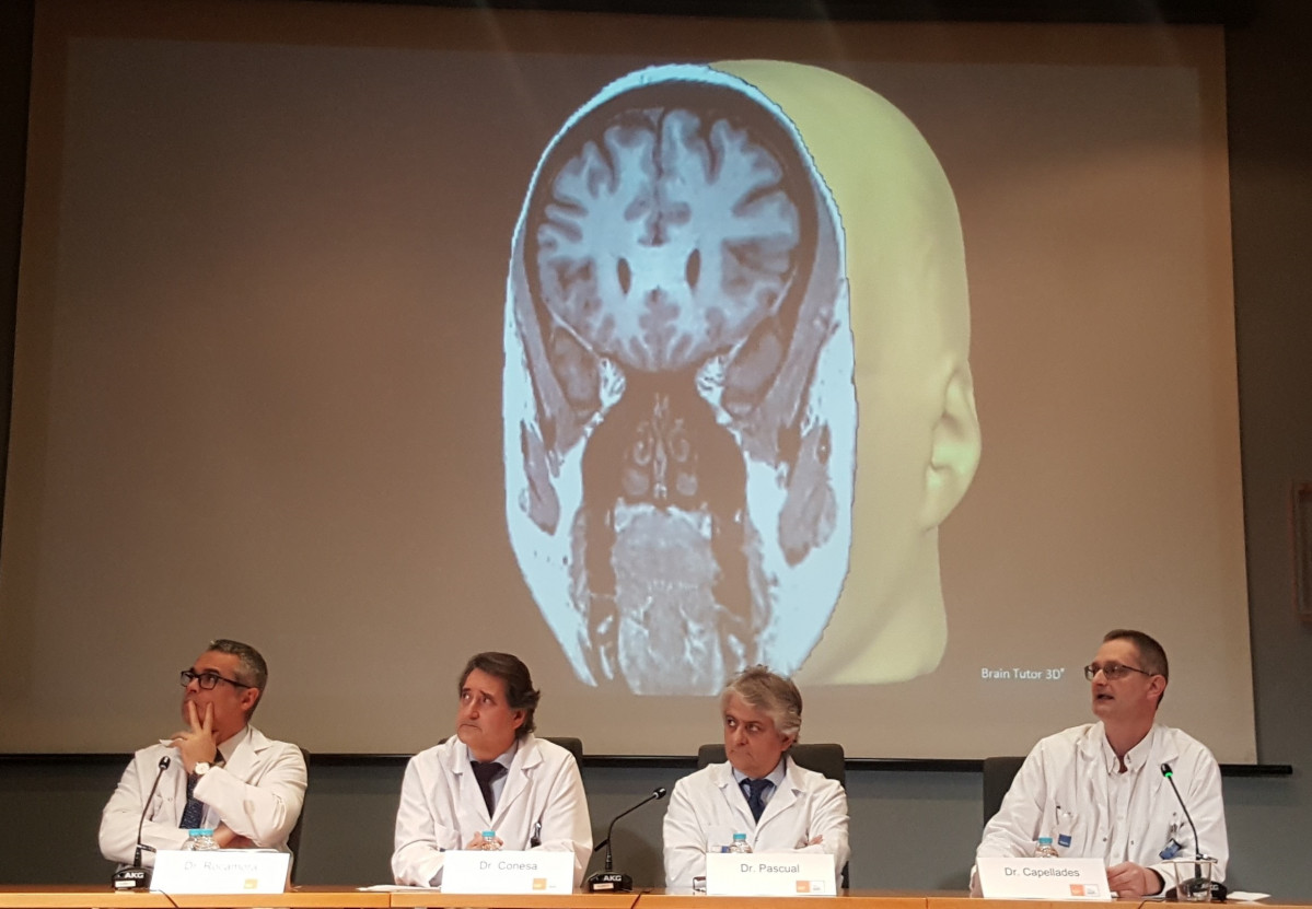 OSPITAL DE MAR OPERA LESIONES CEREBRALES CON ABLACIÓN CON LÁSER