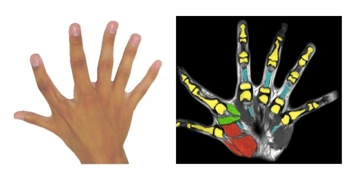 Mano con 6 dedos