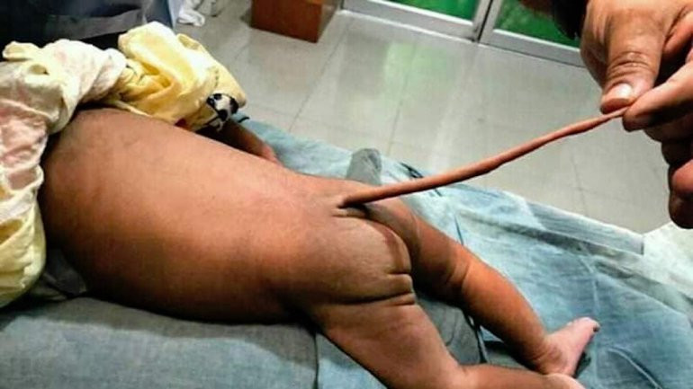 Nace en Colombia un niu00f1o con una cola de 13 centu00edmetros