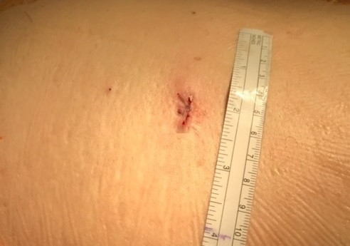 Cirugia espalda fusion vertebral