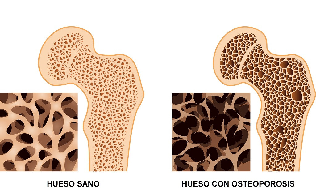 Osteoporosis
