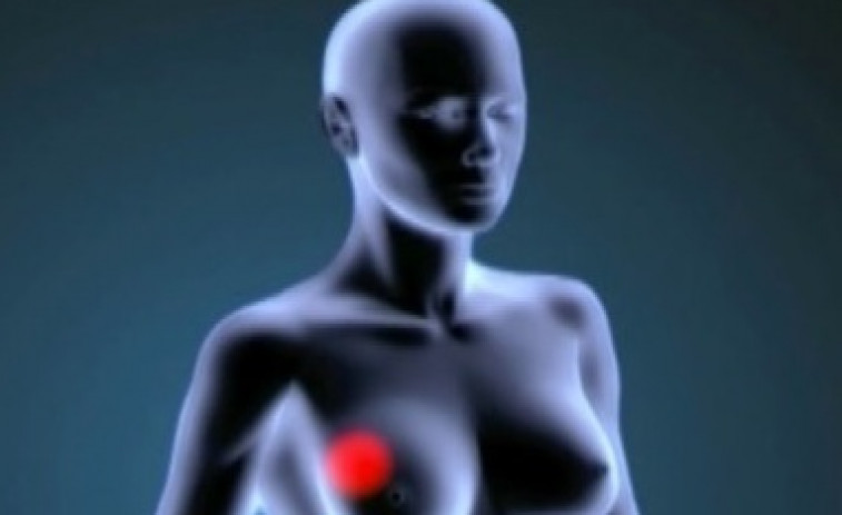 La inteligencia artificial revoluciona la detección temprana del cáncer de mama