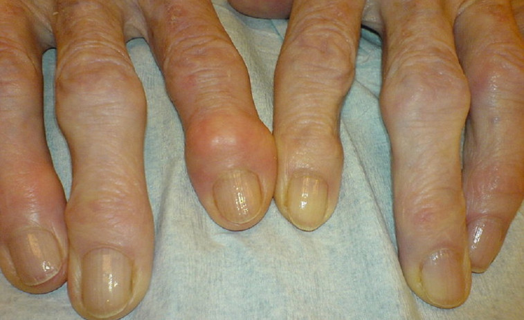 El frío no empeora la artrosis, pero sí puede aumentar el dolor y la rigidez