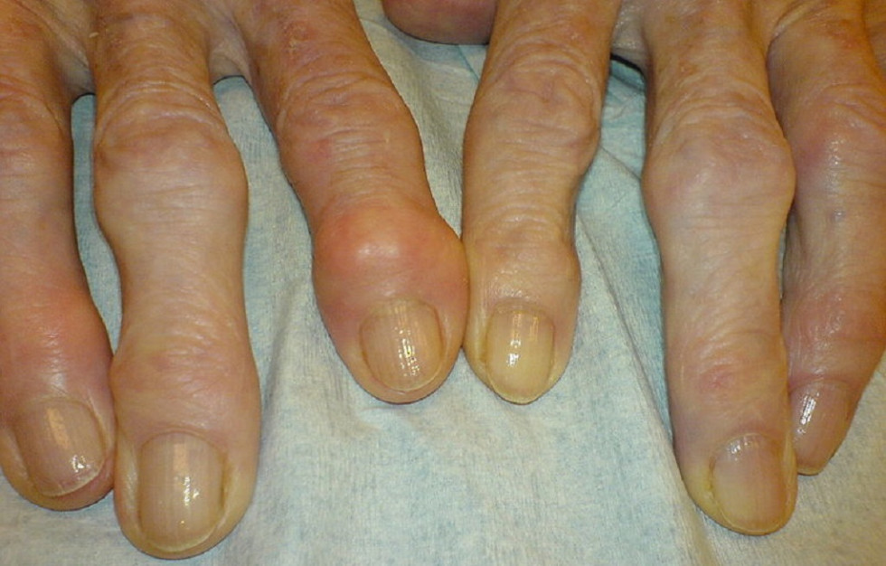 Manos afectadas por la artrosis