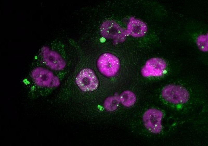 Células tumorales de adenocarcinoma de páncreas