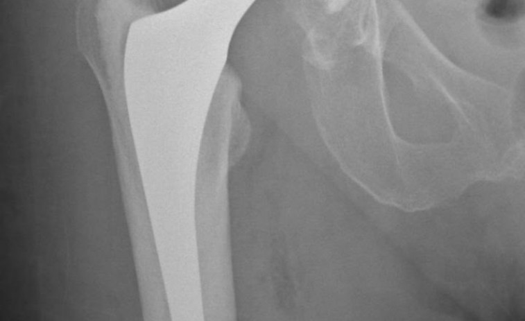 Las fracturas de cadera elevan el riesgo de mortalidad en personas mayores