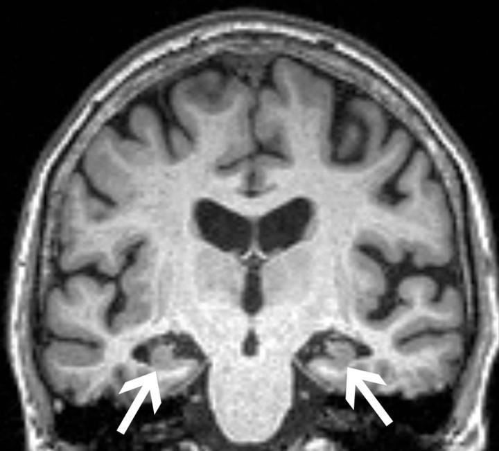 Resonancia magnética del cerebro de una mujer de 72 años muestra la pérdida de volumen del hipocampo (flechas). La paciente tenía las tres características: pérdida de volumen del hipocampo, APOE