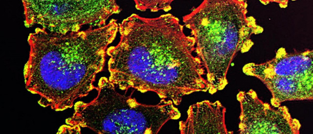 Metastaticmelanomacells ncijuliocvalencia