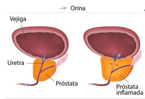 Hiperplasia benigna de prostata
