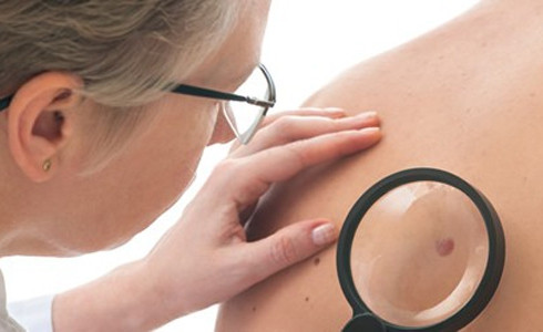Aumenta el número de casos del cáncer de piel en España
