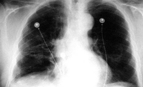 9Radiografía de cáncer de pulmón