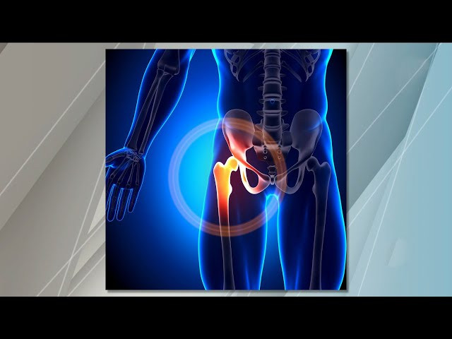 Análisis Epidemiológico Multicéntrico de las Fracturas de Cadera en Uruguay