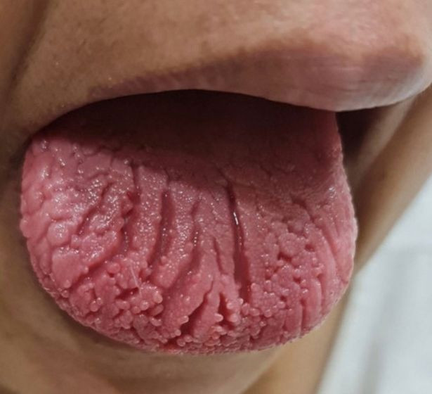 Una mujer sufrió una lesión en la lengua y no pudo comer durante un mes tras recibir la vacuna del Covid-19