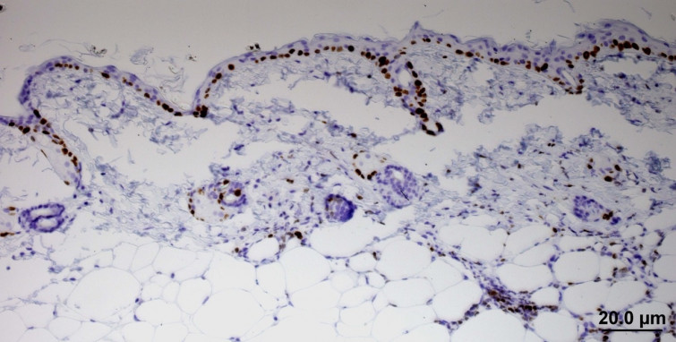 Así consigue el cáncer escapar de la quimioterapia
