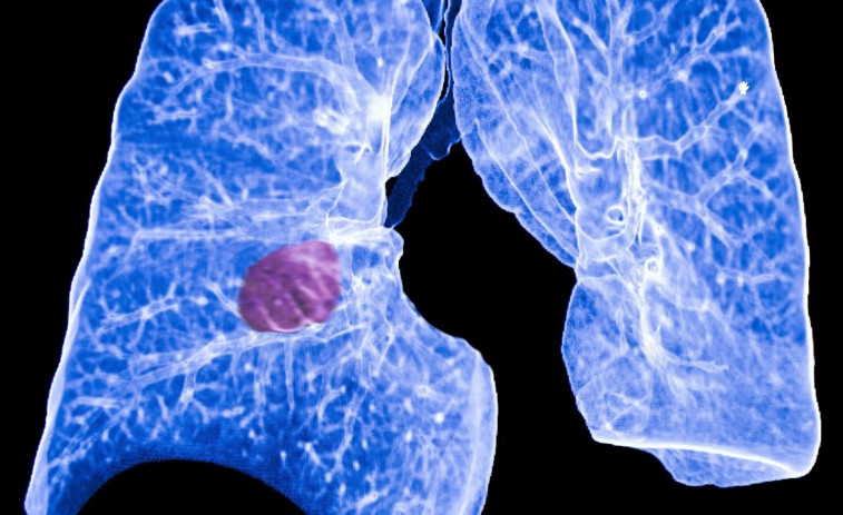 ¿Cómo evitar el cáncer de pulmón?