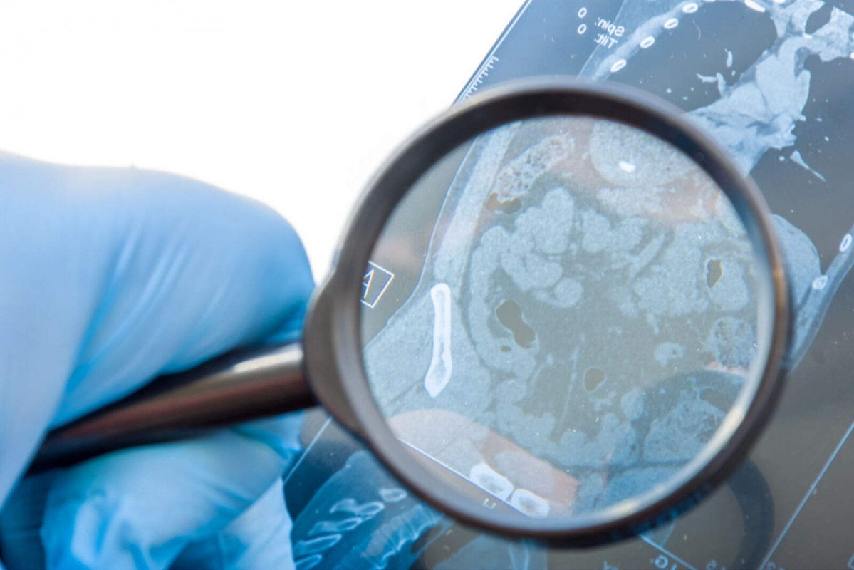 Enfermedades raras 1600 1067