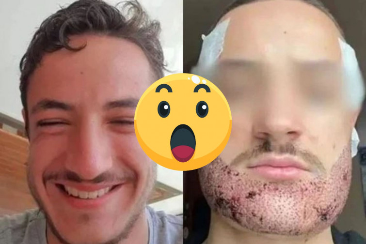 Un joven se suicida después de que le destrocen la cara con un trasplante de barba fallido