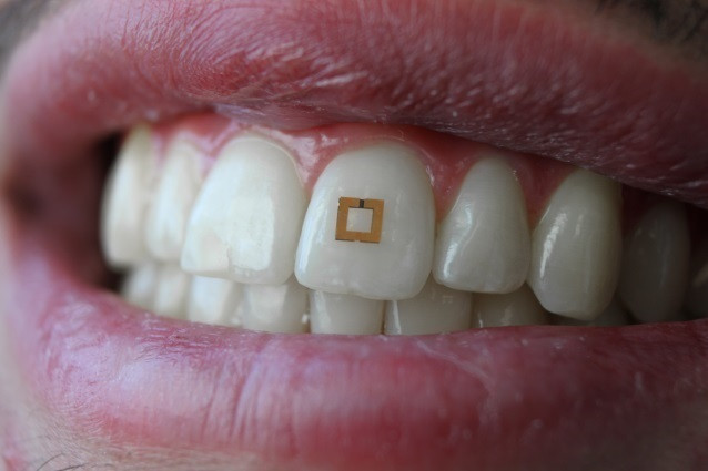 En la última década se han colocado 17 millones de implantes dentales en España