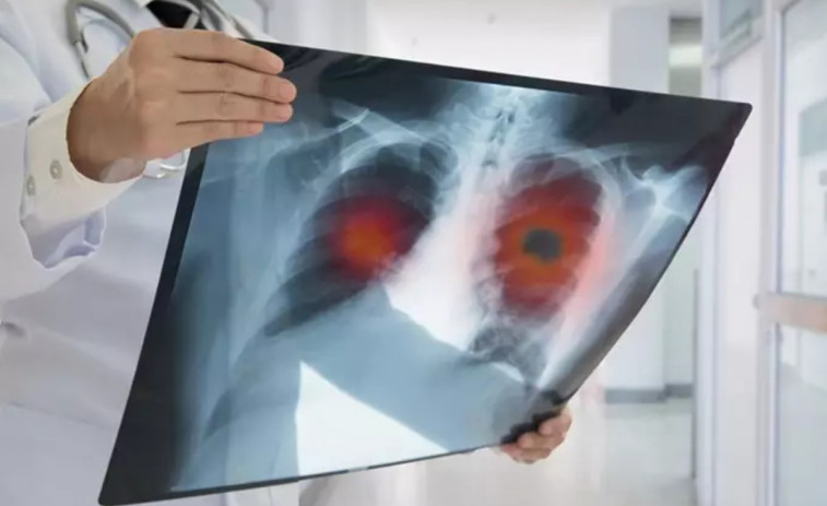 ¿Por qué se están disparando los casos de tuberculosis infantil en Europa?