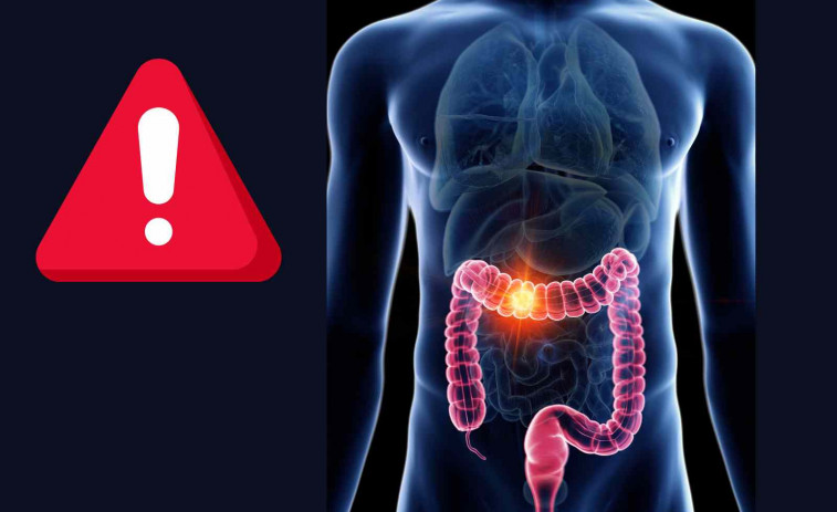 Se disparan los casos de cáncer de cólon entre los más jóvenes: ahora ataca a veinteañeros