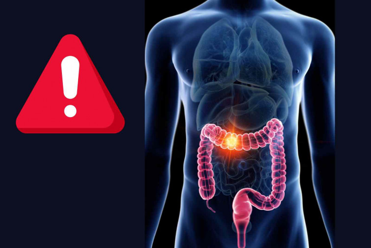 Se disparan los casos de cáncer de cólon entre los más jóvenes: ahora ataca a veinteañeros