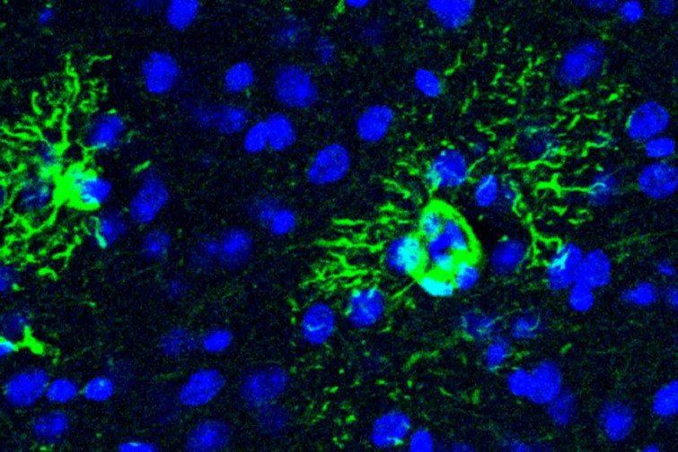 Descubren el posible origen oculto del Alzheimer: una proteína clave podría anticipar la enfermedad