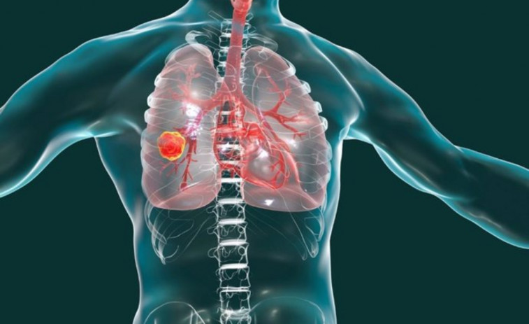 Formación y colaboración internacional: impulso a la investigación del cáncer de pulmón