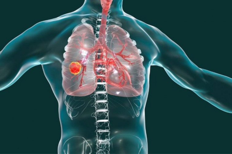Formación y colaboración internacional: impulso a la investigación del cáncer de pulmón