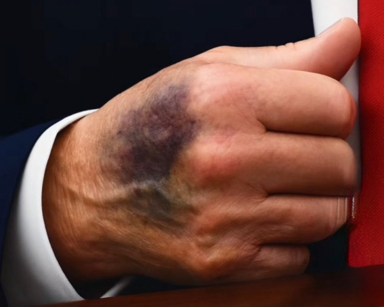 Los medios de EE. UU. investigan la salud de Trump tras fotografías de sus manos