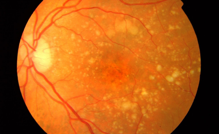 Crean un implante de retina que restaura la visión en pacientes con ceguera degenerativa