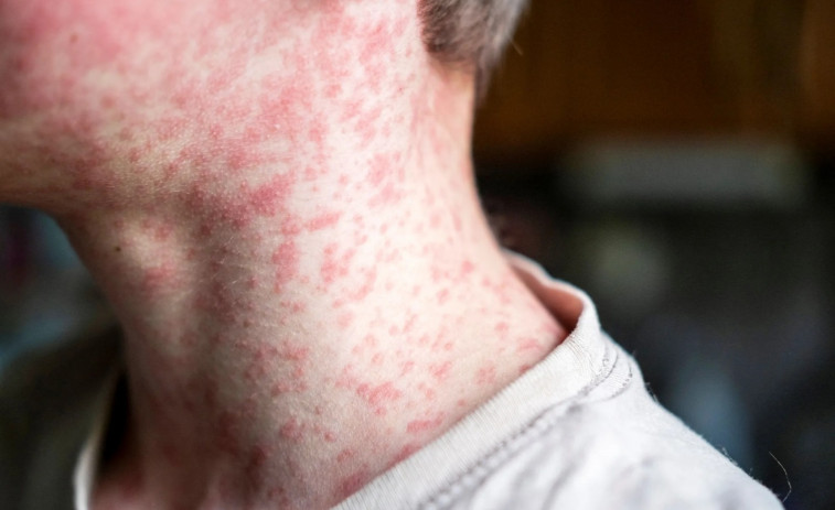 Un éxito de los antivacunas: la OMS retira a España de los países libres de sarampión