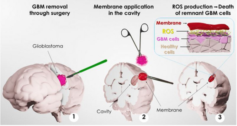 Científicos del ICN2, la UAB y Bellvitge crean un parche para tratar tumores cerebrales agresivos