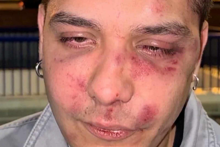 VÍDEO | Un joven denuncia que ha recibido una brutal paliza en Málaga: “Tú eres antifascista, verdad?”
