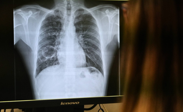 El Hospital Joan XXIII de Tarragona refuerza el dispositivo para atender la tuberculosis