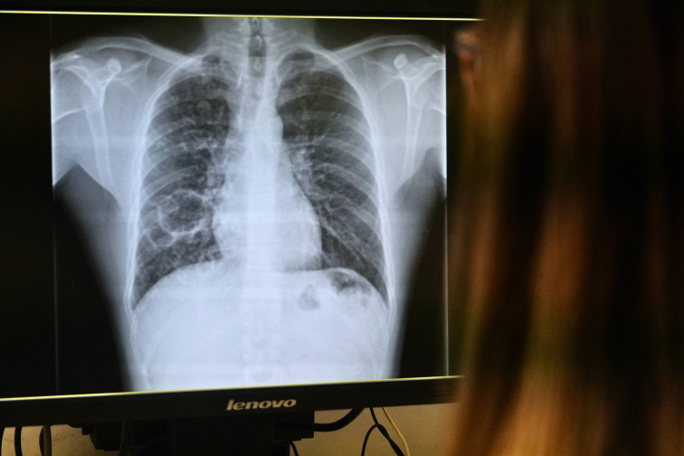 El Hospital Joan XXIII de Tarragona refuerza el dispositivo para atender la tuberculosis