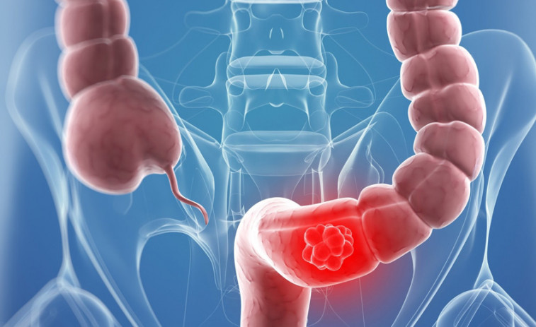 Investigadores encuentran una pieza clave para frenar un subtipo de cáncer de colon y recto